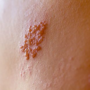 Herpès labial humain, danger pour les lapins