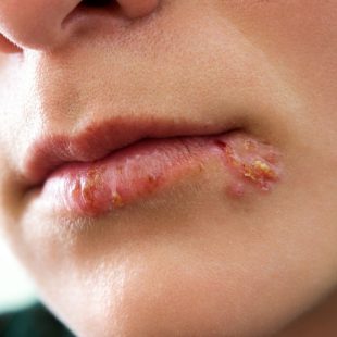 Herpès labial humain, danger pour les lapins